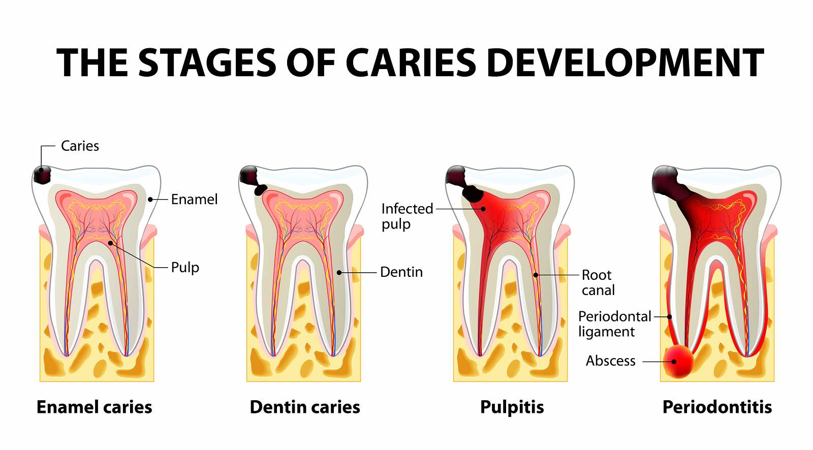 How to Fend Off Dental Caries [INFOGRAPHIC]