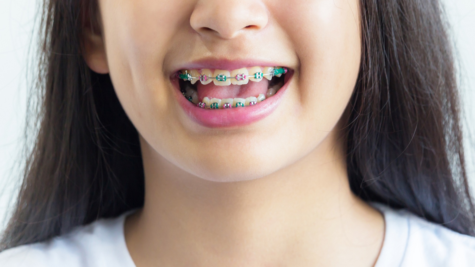 Брекеты на зубы для детей сколько стоят. Детские брекеты. Брекитыдля детей.